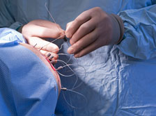 Neuro Surgery Implants